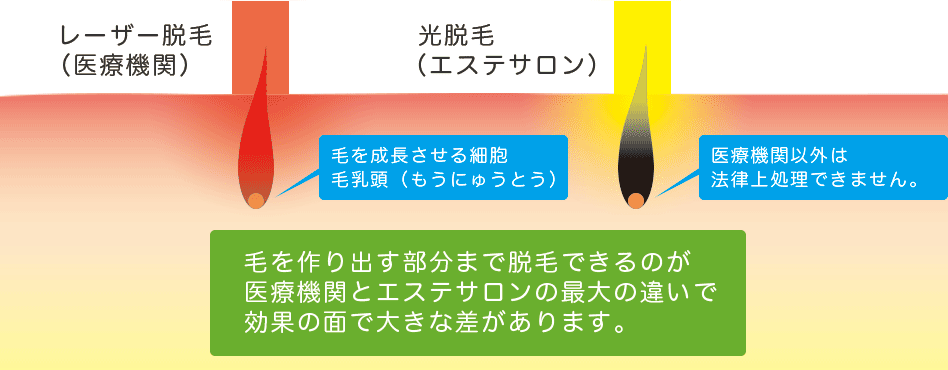 医療とエステの脱毛効果の違い